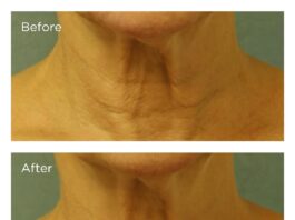 Best Neck Firming Creams before and after