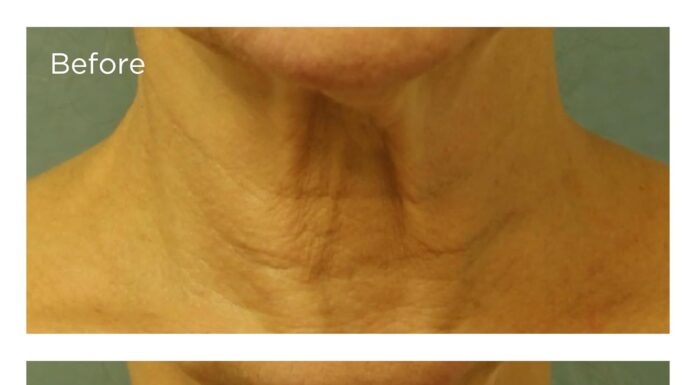 7 Best Neck Firming Creams That Actually Work (Amazon’s Top Picks) Best Neck Firming Creams before and after