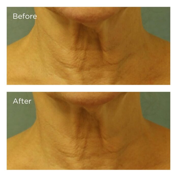 Best Neck Firming Creams before and after