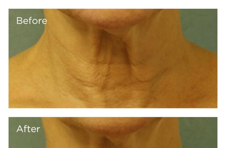 Best Neck Firming Creams before and after